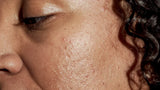 Close up of a cheek with blackheads prior to extractions at Dandle Spa in Chattanooga, TN